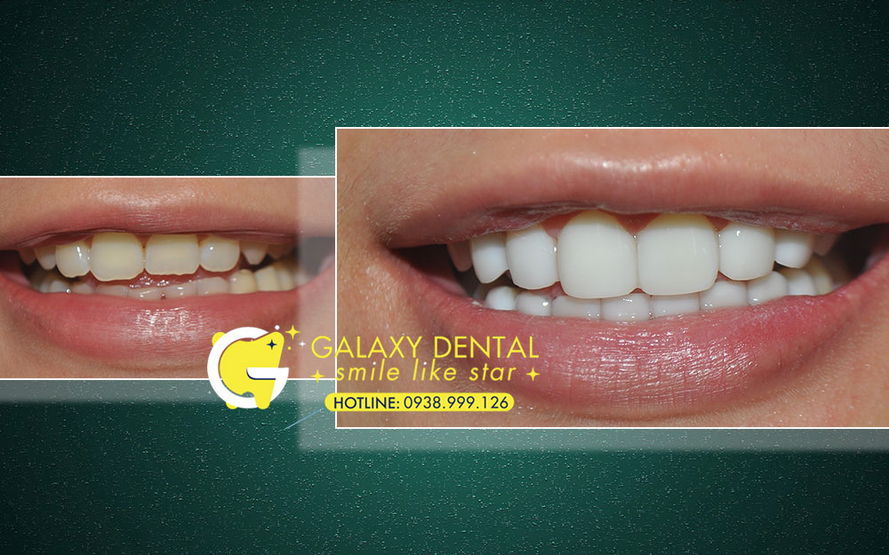 https://bacsynhakhoa.vn/img/galaxy-dental-dap-mat-men-rang-tram-dap-mat-Tran.jpg