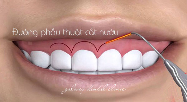 https://bacsynhakhoa.vn/img/galaxy-dental-dieu-tri-cuoi-ho-loi-bang-phuong-phap-cat-nuou.jpg