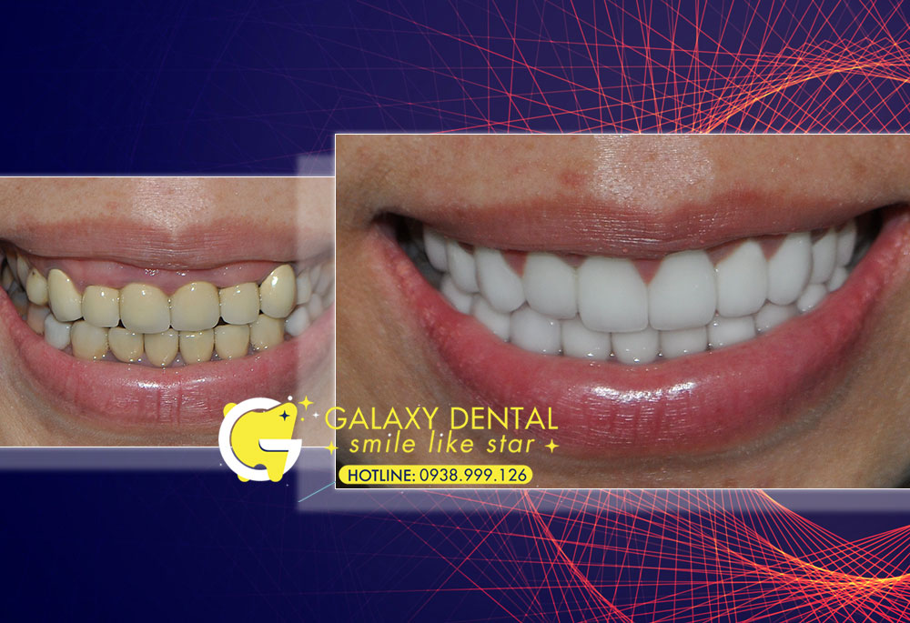 https://bacsynhakhoa.vn/img/galaxy-dental-dieu-tri-cuoi-ho-loi-khong-phau-thuat-Chau-Giang.jpg