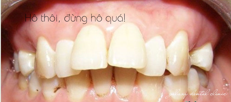 https://bacsynhakhoa.vn/img/galaxy-dental-dieu-tri-rang-ho-nhu-the-nao.jpg