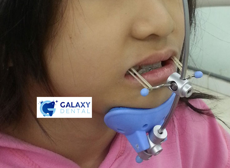 https://bacsynhakhoa.vn/img/galaxy-dental-dieu-tri-rang-mom-cho-tre.jpg