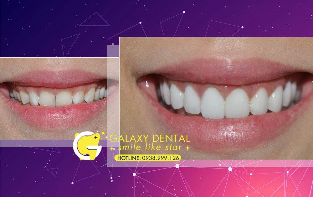 https://bacsynhakhoa.vn/img/galaxy-dental-dieu-tri-rang-su-tham-my-toan-ham-Huynh-Hong-Loan-dien-vien.jpg