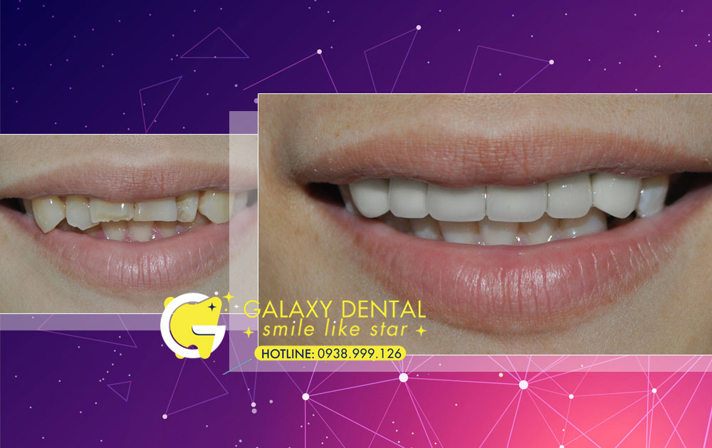 https://bacsynhakhoa.vn/img/galaxy-dental-dieu-tri-rang-su-tham-my-toan-ham-bac-si-Thao-bv-nhi-dong-1.jpg