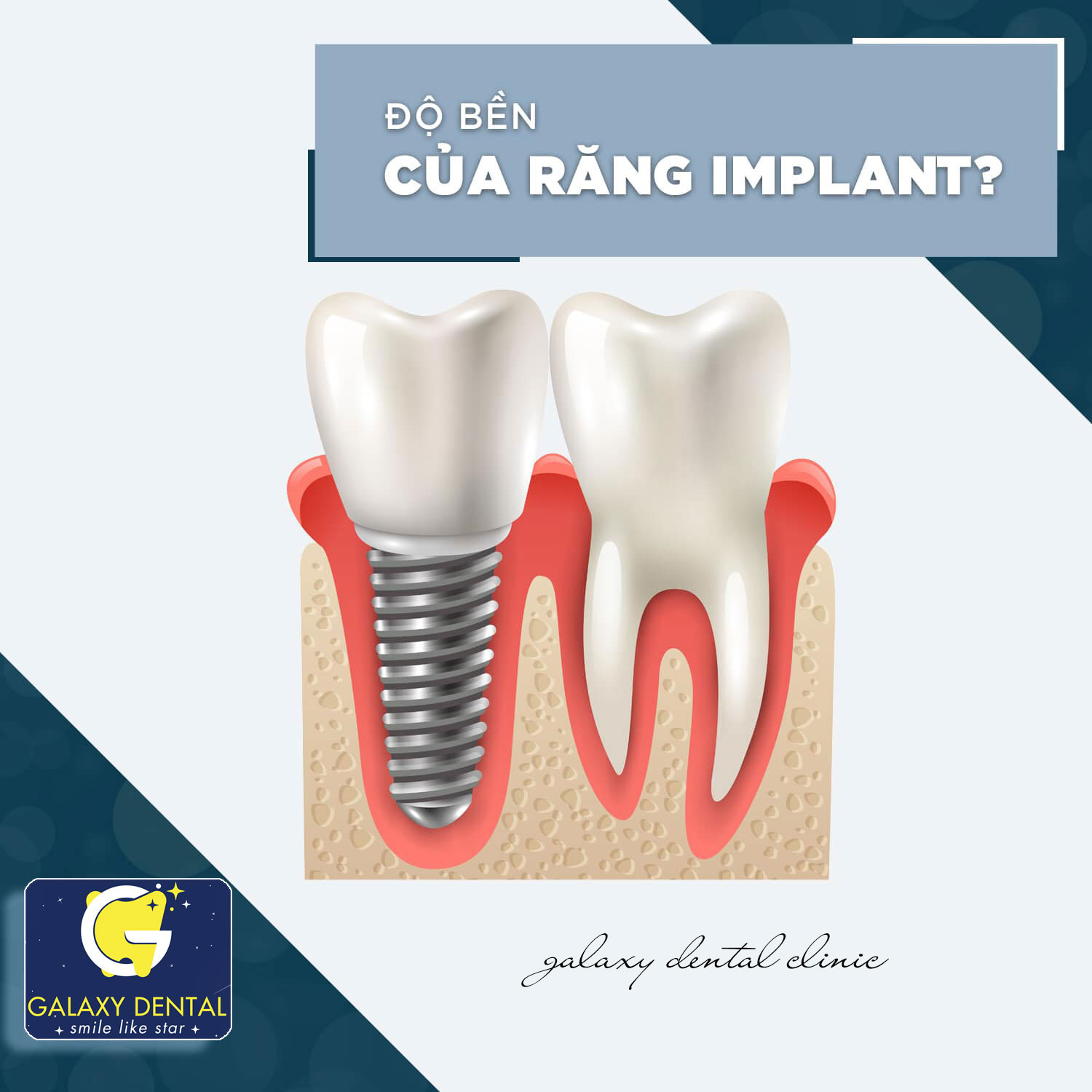 https://bacsynhakhoa.vn/img/galaxy-dental-do-ben-cua-implant.jpg