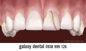 https://bacsynhakhoa.vn/img/galaxy-dental-gay-nut-rang-do-chan-thuong-tai-nan.jpg