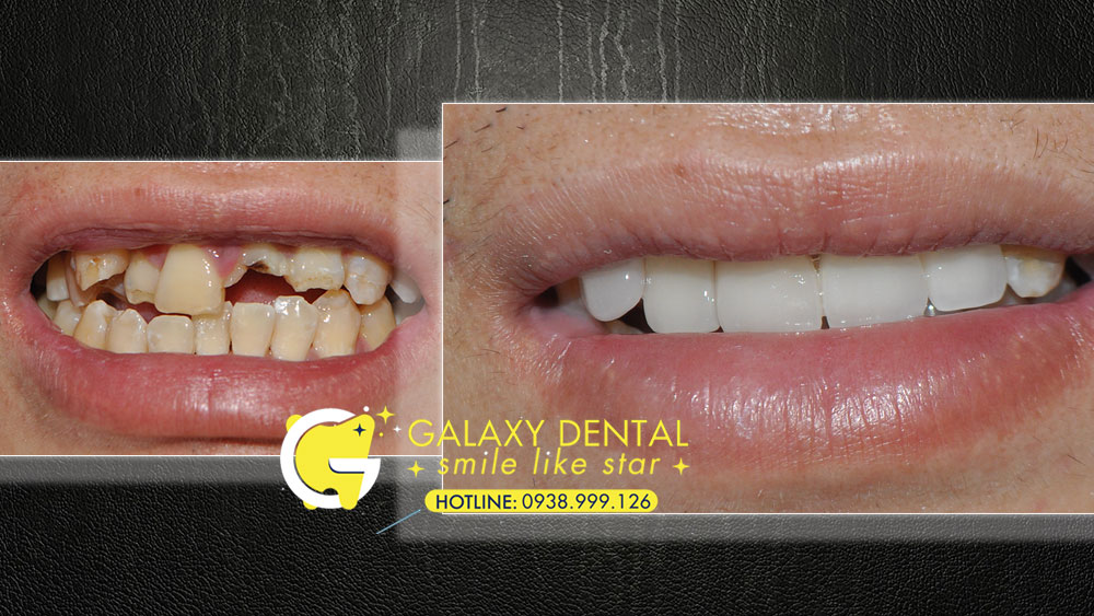 https://bacsynhakhoa.vn/img/galaxy-dental-gay-rang-do-tai-nan-boc-su-Long-Bien-Hoa.jpg