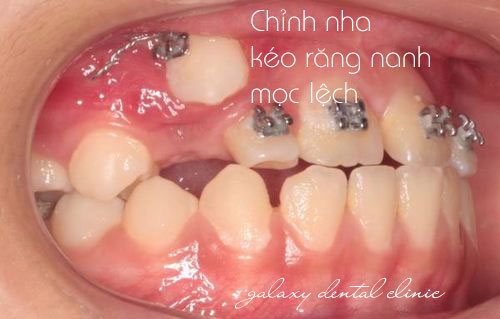 https://bacsynhakhoa.vn/img/galaxy-dental-keo-rang-nanh-moc-ngam-bang-ky-thuat-chinh-nha.jpg