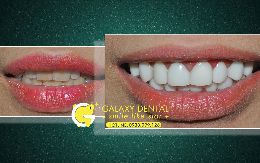 https://bacsynhakhoa.vn/img/galaxy-dental-khoac-ao-moi-cho-rang-veneer-Tuyet.jpg