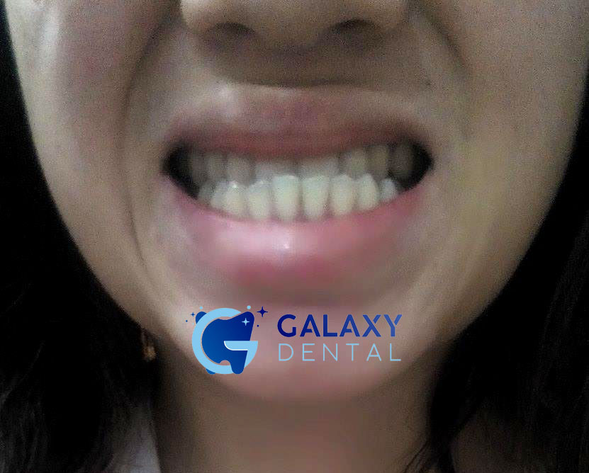 https://bacsynhakhoa.vn/img/galaxy-dental-khop-can-nguoc-o-nguoi-lon.jpg