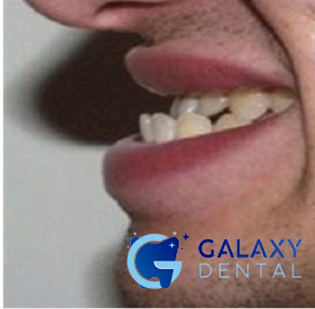 https://bacsynhakhoa.vn/img/galaxy-dental-khop-can-nguoc-o-nguoi-truong-thanh.jpg