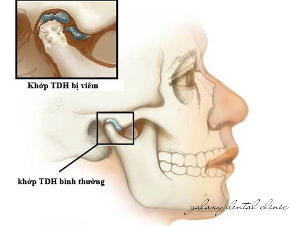 https://bacsynhakhoa.vn/img/galaxy-dental-khop-thai-duong-ham-bi-viem.jpg