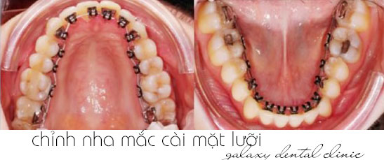 https://bacsynhakhoa.vn/img/galaxy-dental-ky-thuat-nieng-rang-mac-cai-mat-luoi-mat-trong02.jpg