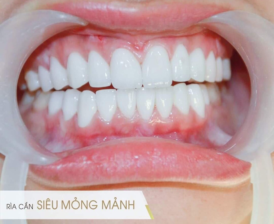 https://bacsynhakhoa.vn/img/galaxy-dental-lam-rang-su-o-dau-dep-sai-gon.jpg