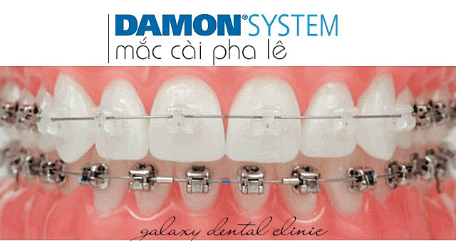 https://bacsynhakhoa.vn/img/galaxy-dental-mac-cai-chinh-nha-pha-le.jpg