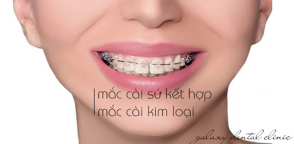 https://bacsynhakhoa.vn/img/galaxy-dental-mac-cai-su-ket-hop-mac-cai-kim-loai-trong-chinh-nha.jpg