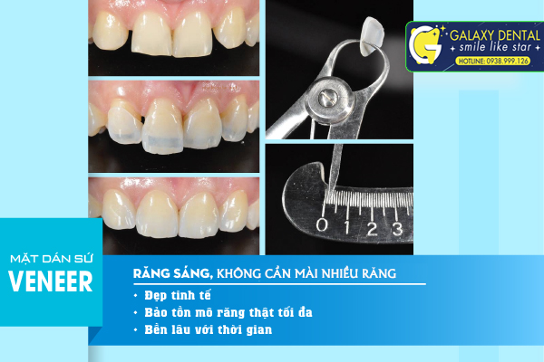 https://bacsynhakhoa.vn/img/galaxy-dental-mat-dan-veneer.jpg