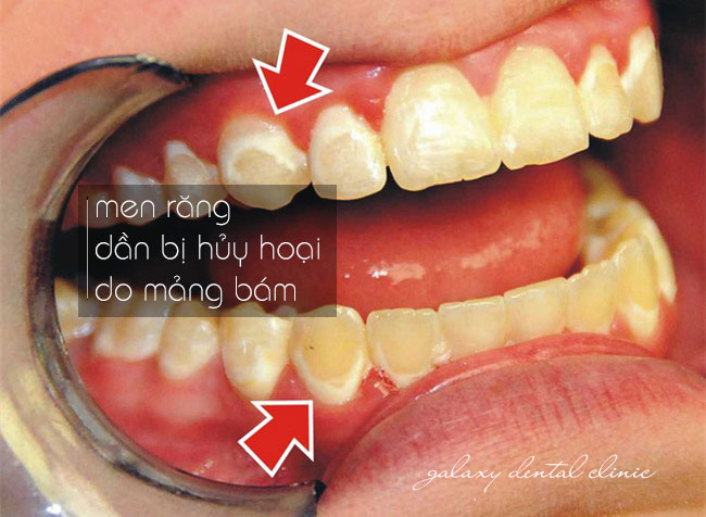 https://bacsynhakhoa.vn/img/galaxy-dental-men-rang-bi-huy-hoai-do-mang-bam.jpg