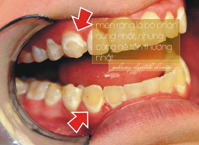 Răng là bộ phận cứng nhất nhưng dễ tổn thương nhất
