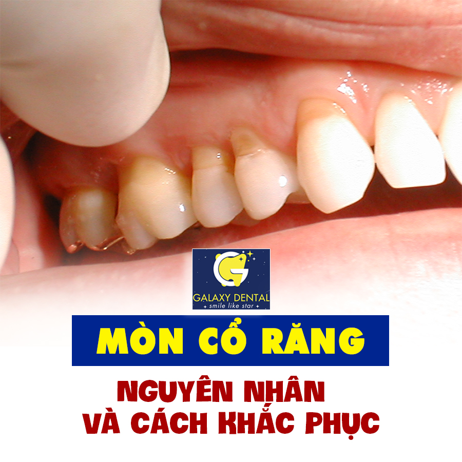 https://bacsynhakhoa.vn/img/galaxy-dental-mon-co-chan-rang.jpg