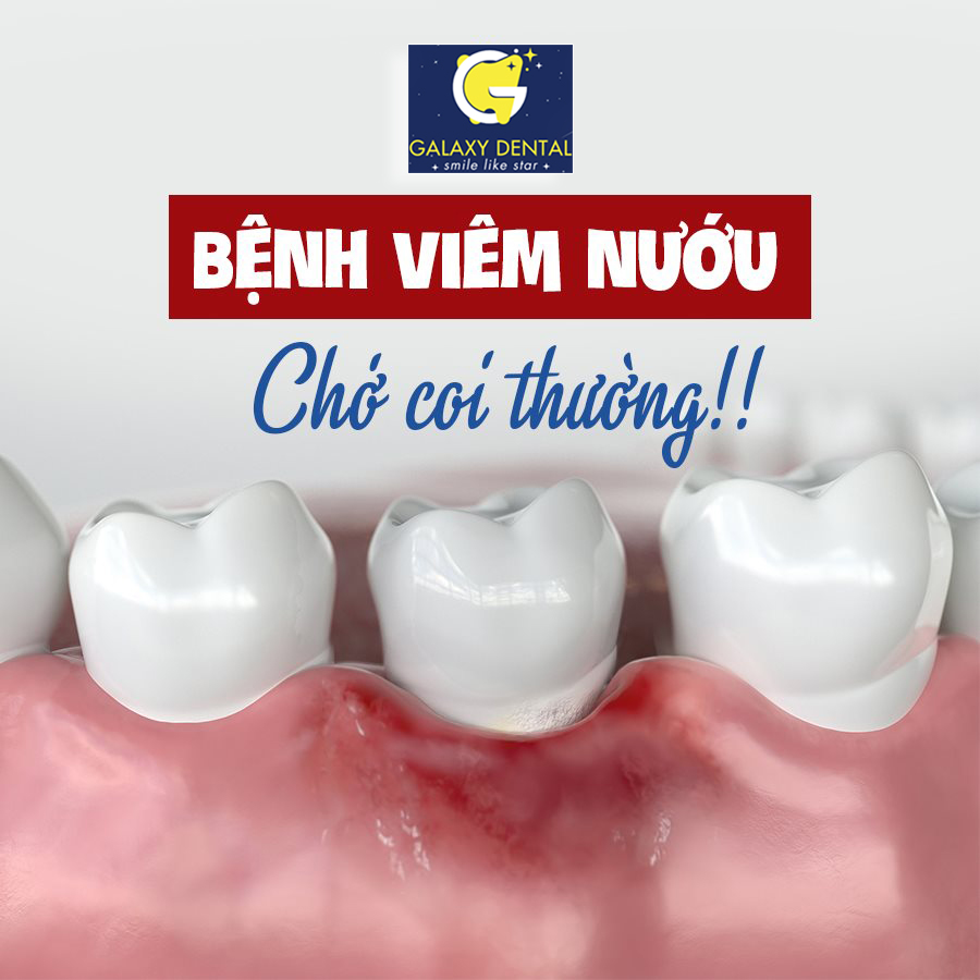 https://bacsynhakhoa.vn/img/galaxy-dental-nguy-co-mat-rang-vi-viem-nuou.jpg