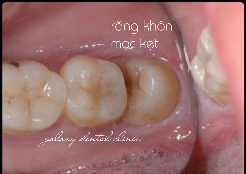 https://bacsynhakhoa.vn/img/galaxy-dental-nho-rang-khon-het-bao-nhieu-tien.jpg