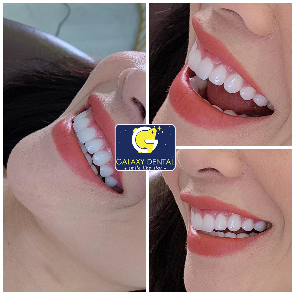 https://bacsynhakhoa.vn/img/galaxy-dental-nu-cuoi.jpg