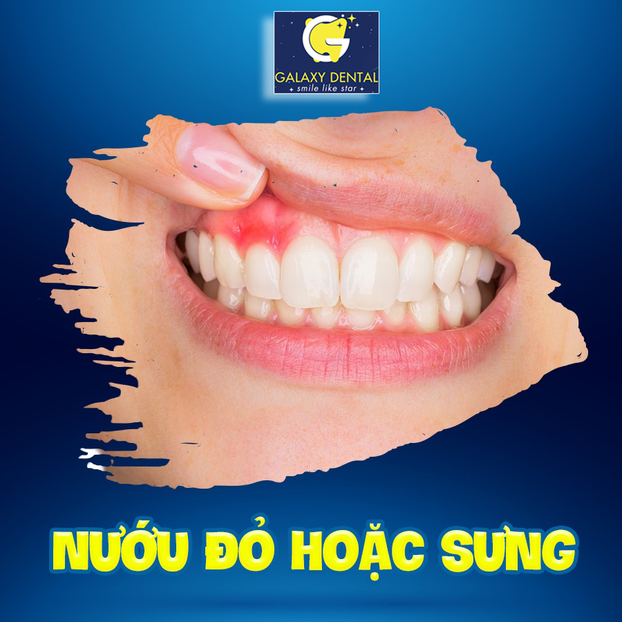 https://bacsynhakhoa.vn/img/galaxy-dental-nuou-do-hoac-sung-tay.jpg