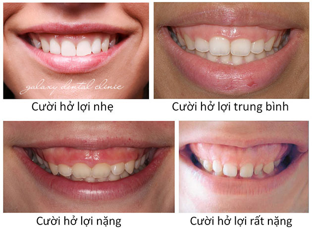 https://bacsynhakhoa.vn/img/galaxy-dental-phan-loai-muc-do-cuoi-ho-loi.jpg