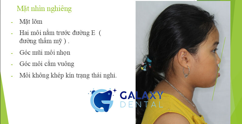 https://bacsynhakhoa.vn/img/galaxy-dental-phan-tich-khop-can-nguoc-chukieubaochau.jpg