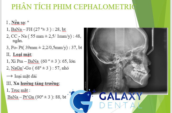 https://bacsynhakhoa.vn/img/galaxy-dental-phan-tich-phim-so-nghieng.jpg