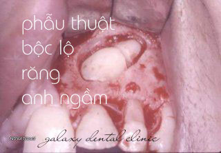 https://bacsynhakhoa.vn/img/galaxy-dental-phau-thuat-boc-lo-rang-nanh-ngam.jpg