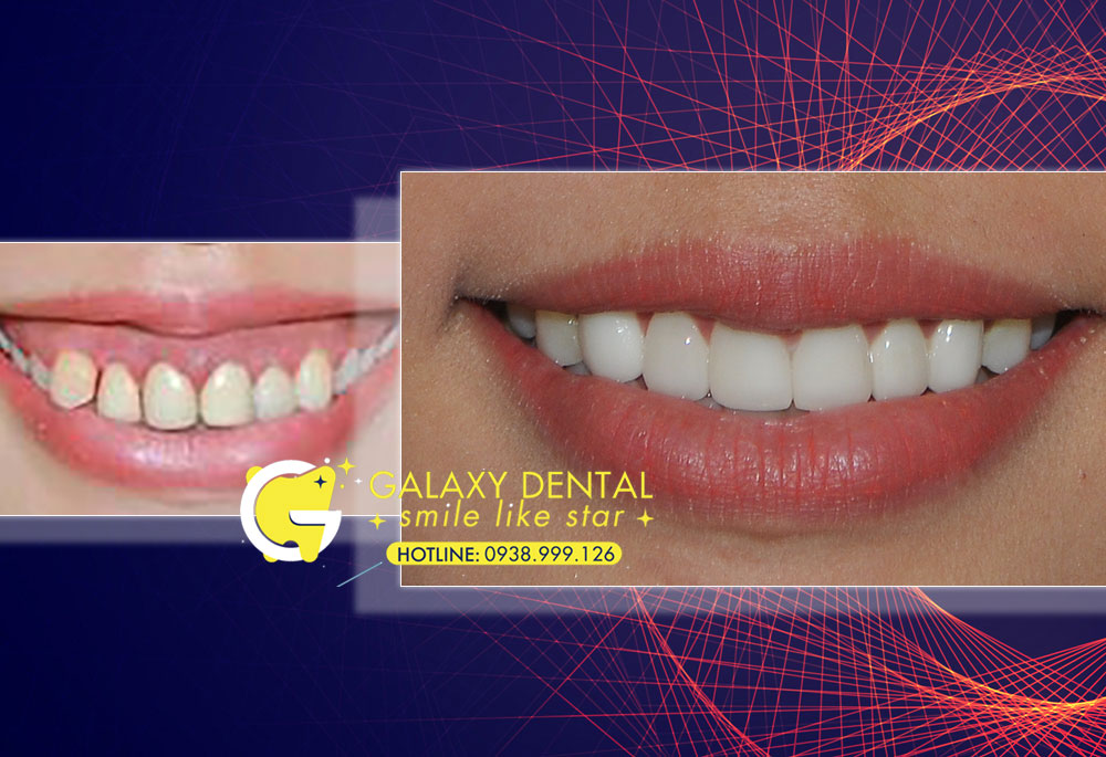 https://bacsynhakhoa.vn/img/galaxy-dental-phau-thuat-dieu-tri-cuoi-ho-loi-gummy-smile.jpg