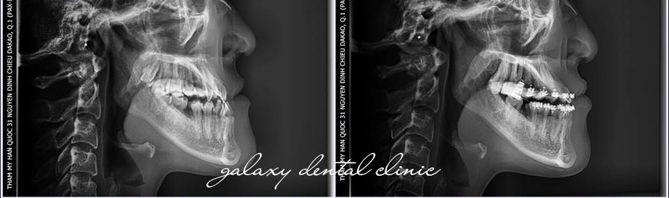 https://bacsynhakhoa.vn/img/galaxy-dental-phim-chup-so-nghieng-sephalo.jpg