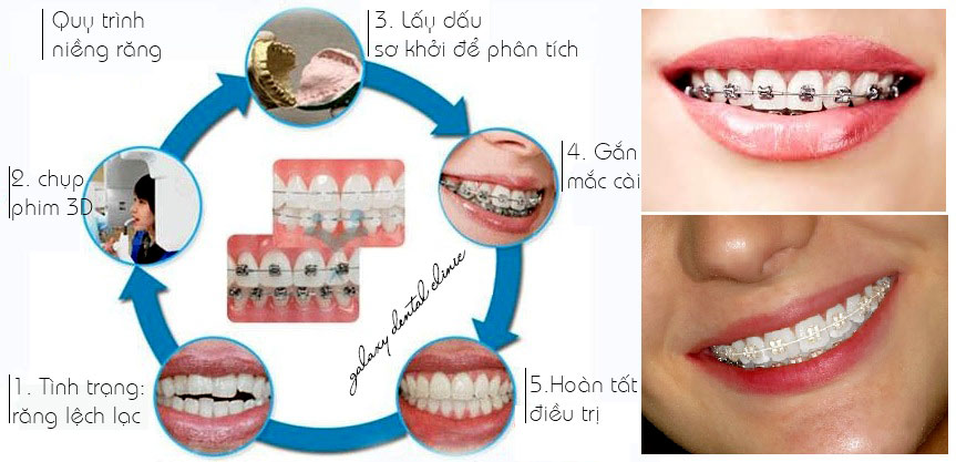 https://bacsynhakhoa.vn/img/galaxy-dental-quy-trinh-nieng-rang.jpg