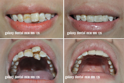 https://bacsynhakhoa.vn/img/galaxy-dental-rang-cua-moc-lech-do-rang-du.jpg