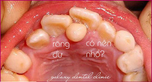 https://bacsynhakhoa.vn/img/galaxy-dental-rang-du-co-nen-nho-khong.jpg