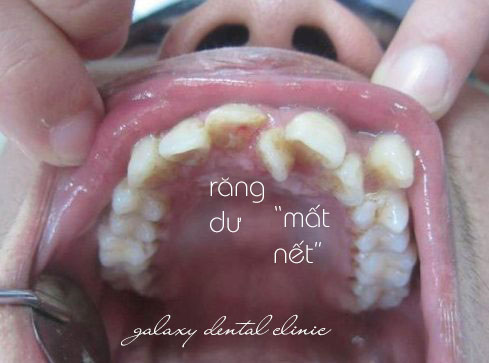 https://bacsynhakhoa.vn/img/galaxy-dental-rang-du-o-giua-hai-rang-cua.jpg