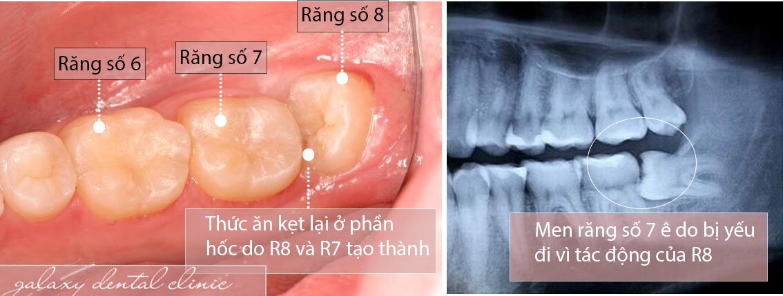 https://bacsynhakhoa.vn/img/galaxy-dental-rang-khon-moc-lech-moc-ket-gay-nhet-thuc-an.jpg