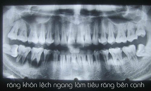 https://bacsynhakhoa.vn/img/galaxy-dental-rang-khon-moc-ngang.jpg