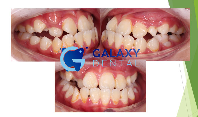 https://bacsynhakhoa.vn/img/galaxy-dental-rang-mom-khop-can-nguoc-baochau.jpg