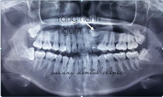 https://bacsynhakhoa.vn/img/galaxy-dental-rang-nanh-moc-ngam.jpg