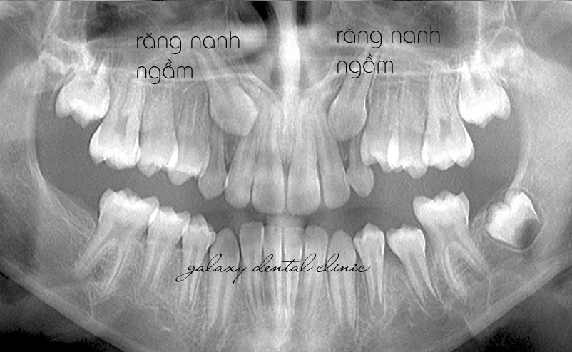 https://bacsynhakhoa.vn/img/galaxy-dental-rang-nanh-ngam.jpg