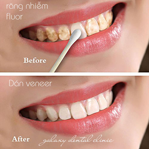 https://bacsynhakhoa.vn/img/galaxy-dental-rang-nhiem-flour-co-tay-trang-duoc-khong.jpg