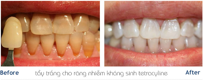 https://bacsynhakhoa.vn/img/galaxy-dental-rang-nhiem-khang-sinh-co-tay-trang-duoc-khong.jpg