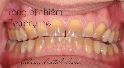 https://bacsynhakhoa.vn/img/galaxy-dental-rang-nhiem-khang-sinh-tetracyline-co-mau-xam.jpg