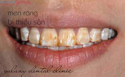 https://bacsynhakhoa.vn/img/galaxy-dental-rang-nhiem-tetracycline.jpg