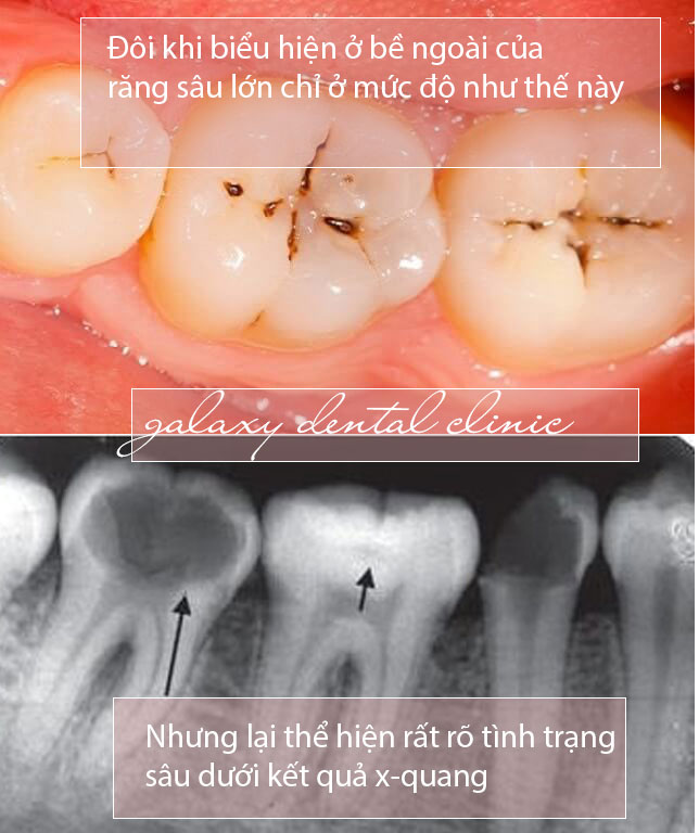 https://bacsynhakhoa.vn/img/galaxy-dental-rang-sau.jpg