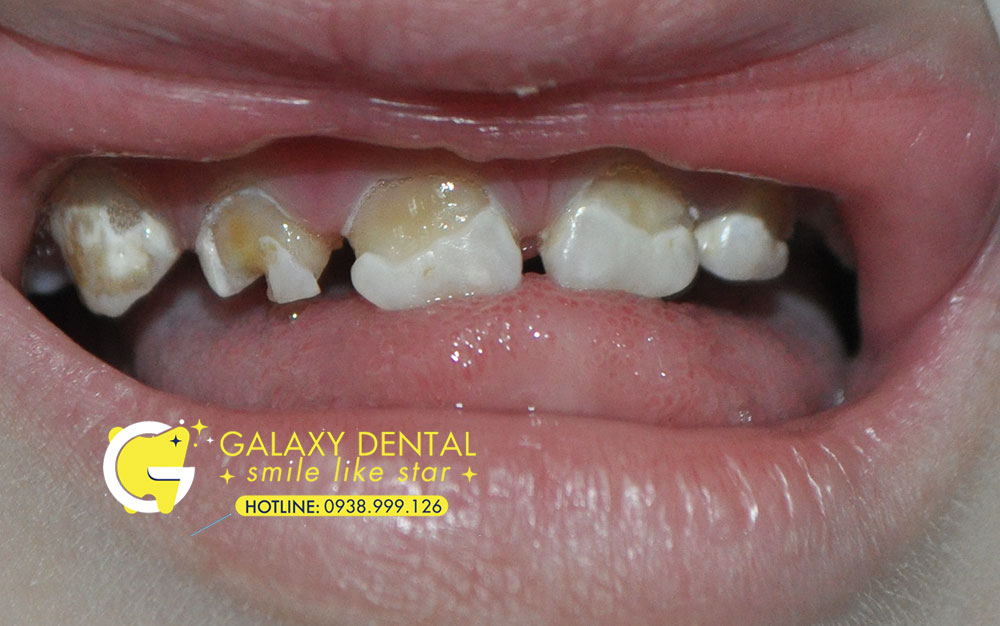 https://bacsynhakhoa.vn/img/galaxy-dental-rang-sua-bi-mun.jpg