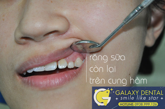 https://bacsynhakhoa.vn/img/galaxy-dental-rang-sua-con-lai-cung-rang-that.jpg