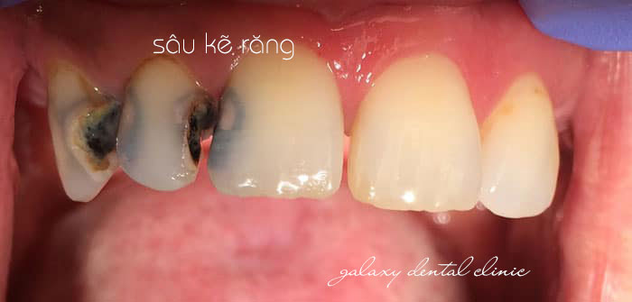 https://bacsynhakhoa.vn/img/galaxy-dental-sau-ke-rang.jpg